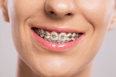 Aparelho Dentário (tratamento ortodontico) em Campinas